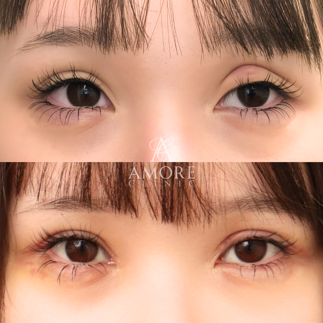 二重全切開（他院修正）＋たるみ除去＋脂肪除去＋ライン変更＋癒着解除＋埋没糸抜去