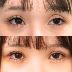 二重全切開（他院修正）＋たるみ除去＋脂肪除去＋ライン変更＋癒着解除＋埋没糸抜去