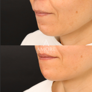 傷跡修正（切開法）