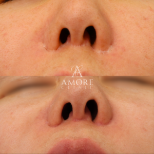 人中短縮後の傷跡修正（グラデーション加工）