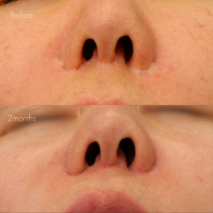 人中短縮後の傷跡修正（グラデーション加工）