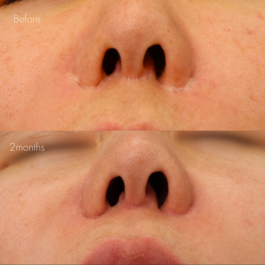 人中短縮後の傷跡修正（グラデーション加工）