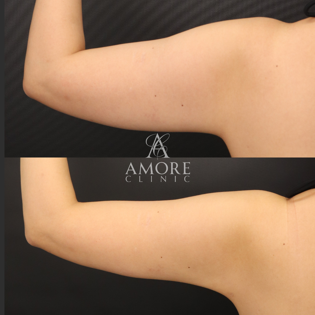 二の腕脂肪吸引