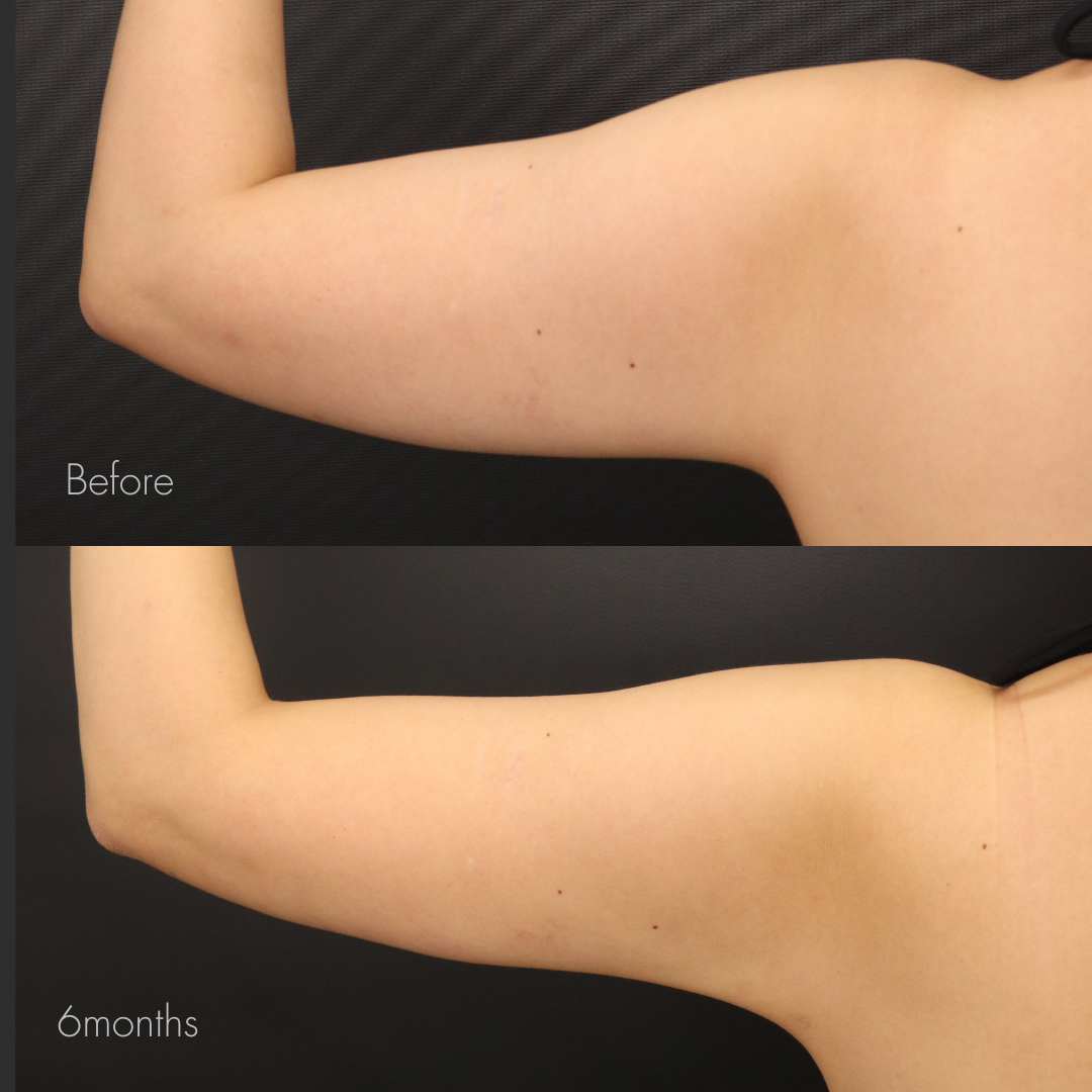 二の腕脂肪吸引