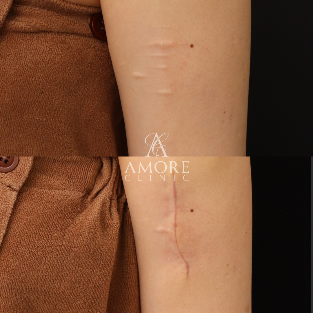 アームカットの傷跡修正（切開法）