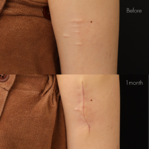 アームカットの傷跡修正（切開法）