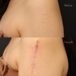 アームカットの傷跡修正（切開法）