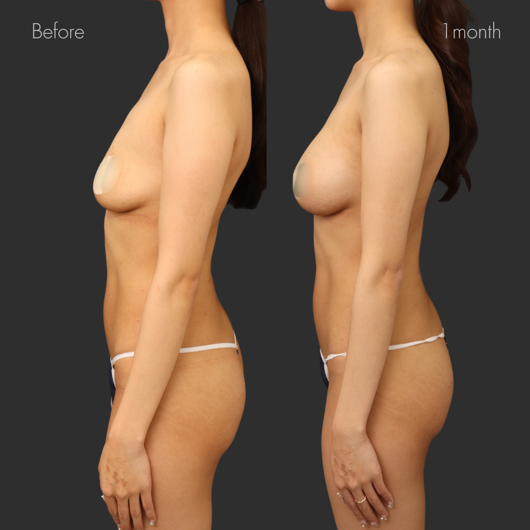 シリコンバッグ豊胸（モティバ275cc）