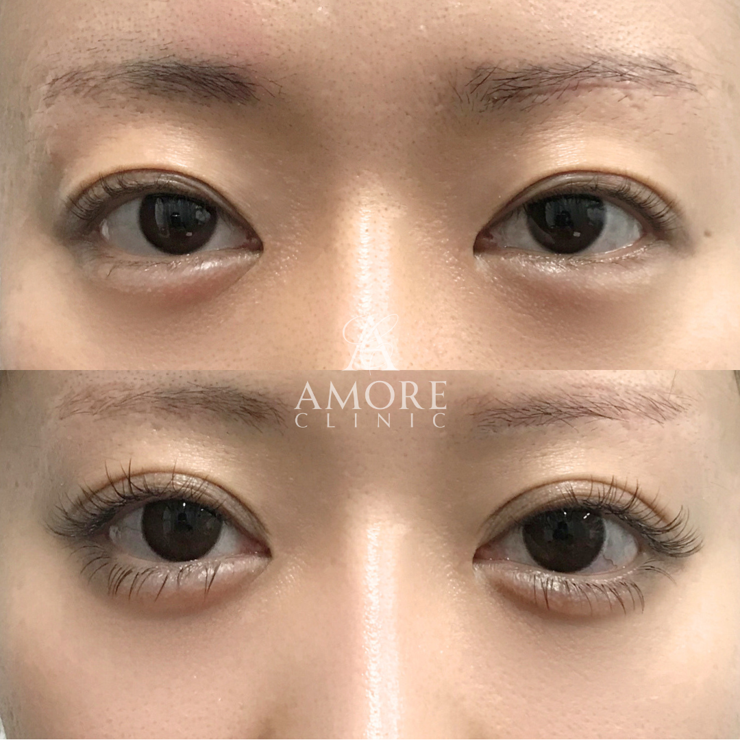 二重全切開（他院修正）＋たるみ取り＋ライン変更＋剥離