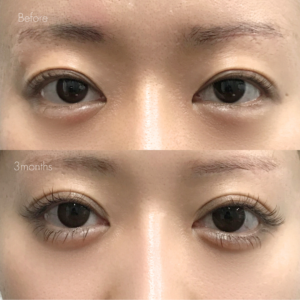 二重全切開（他院修正）＋たるみ取り＋ライン変更＋剥離