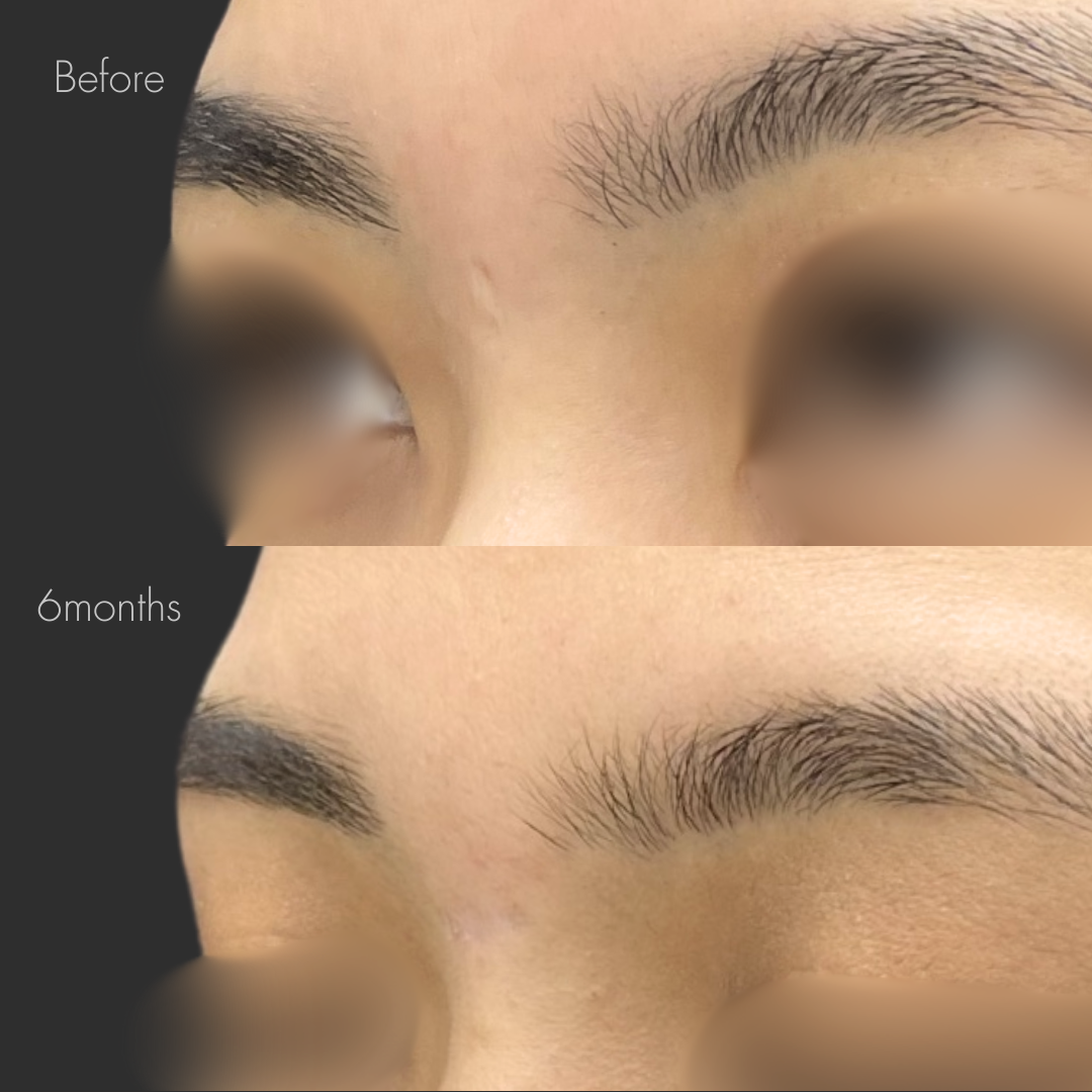 ホクロ除去後の傷跡修正（切開法）