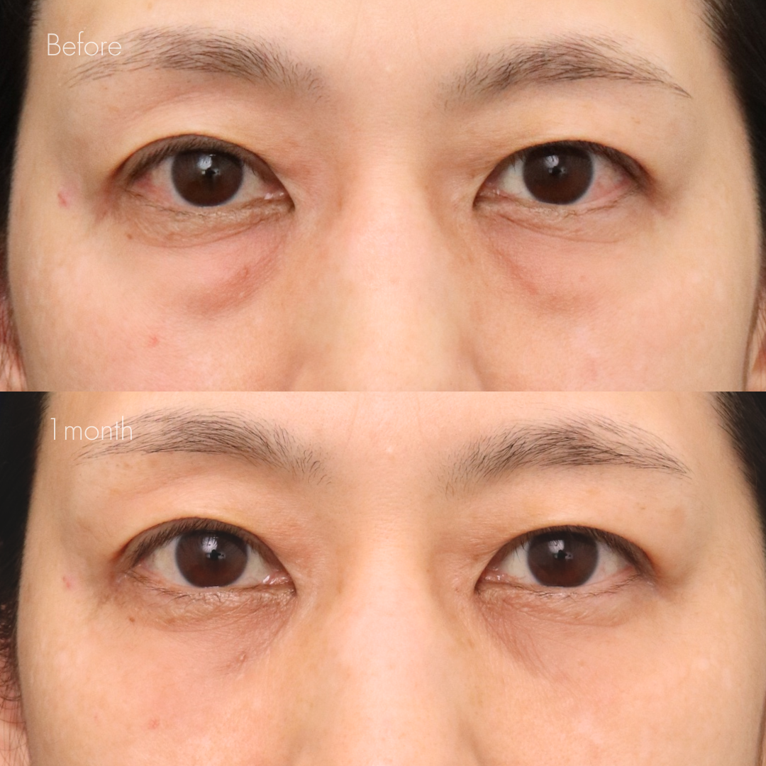 下眼瞼脱脂 （結膜側）