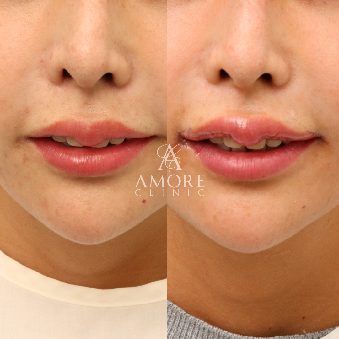 M字リップ・口角挙上