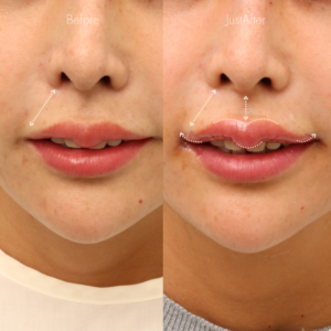 M字リップ・口角挙上