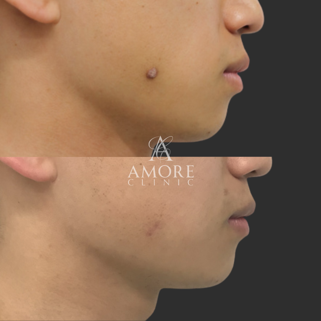 ケロイド除去（切開法）