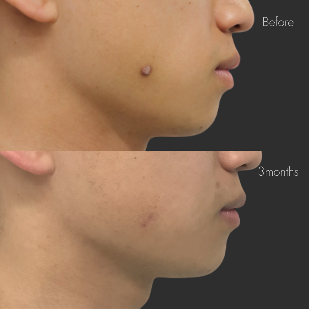 ケロイド除去（切開法）