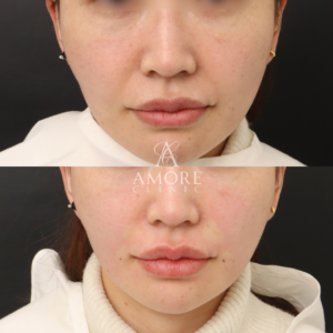 貴族リフト（8本）