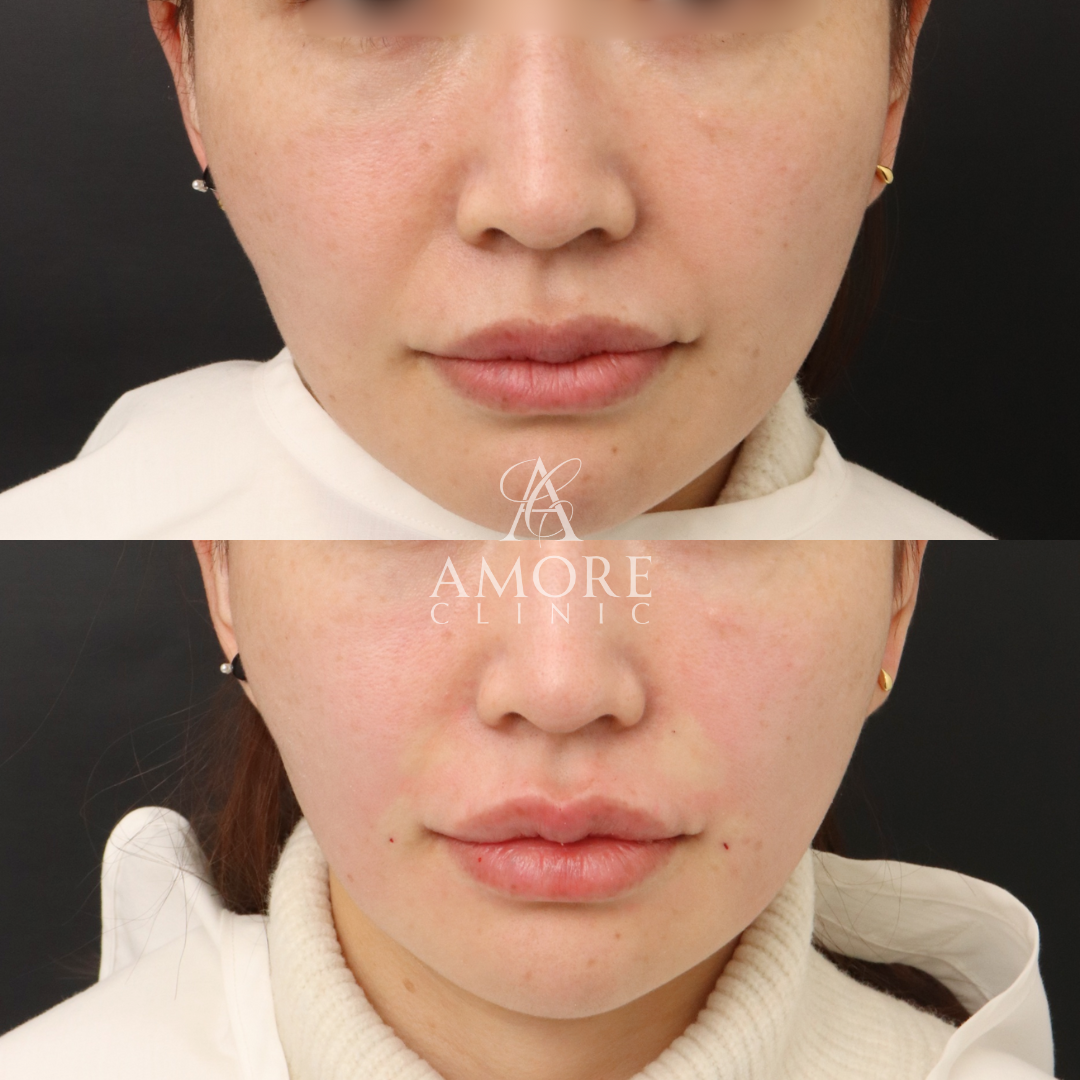 貴族リフト（8本）