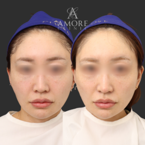 鼻尖縮小＋耳介軟骨移植＋鼻孔縁挙上＋鼻翼挙上