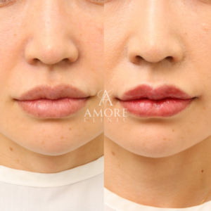 リップフルセット（M字リップ・口角挙上・ピーナッツリップ）