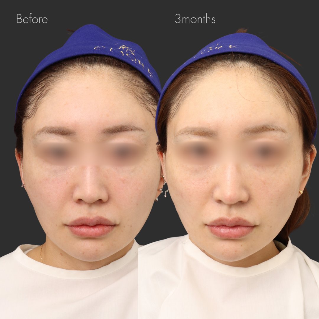 鼻尖縮小＋耳介軟骨移植＋鼻孔縁挙上＋鼻翼挙上