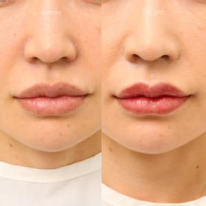 リップフルセット（M字リップ・口角挙上・ピーナッツリップ）