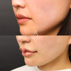 リップフルセット（M字リップ・口角挙上・ピーナッツリップ）