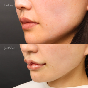 リップフルセット（M字リップ・口角挙上・ピーナッツリップ）