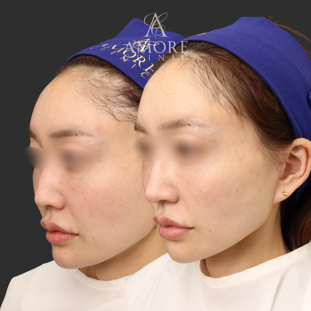 鼻尖縮小＋耳介軟骨移植＋鼻孔縁挙上＋鼻翼挙上