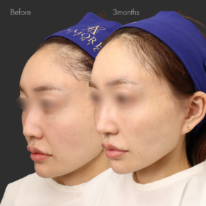 鼻尖縮小＋耳介軟骨移植＋鼻孔縁挙上＋鼻翼挙上