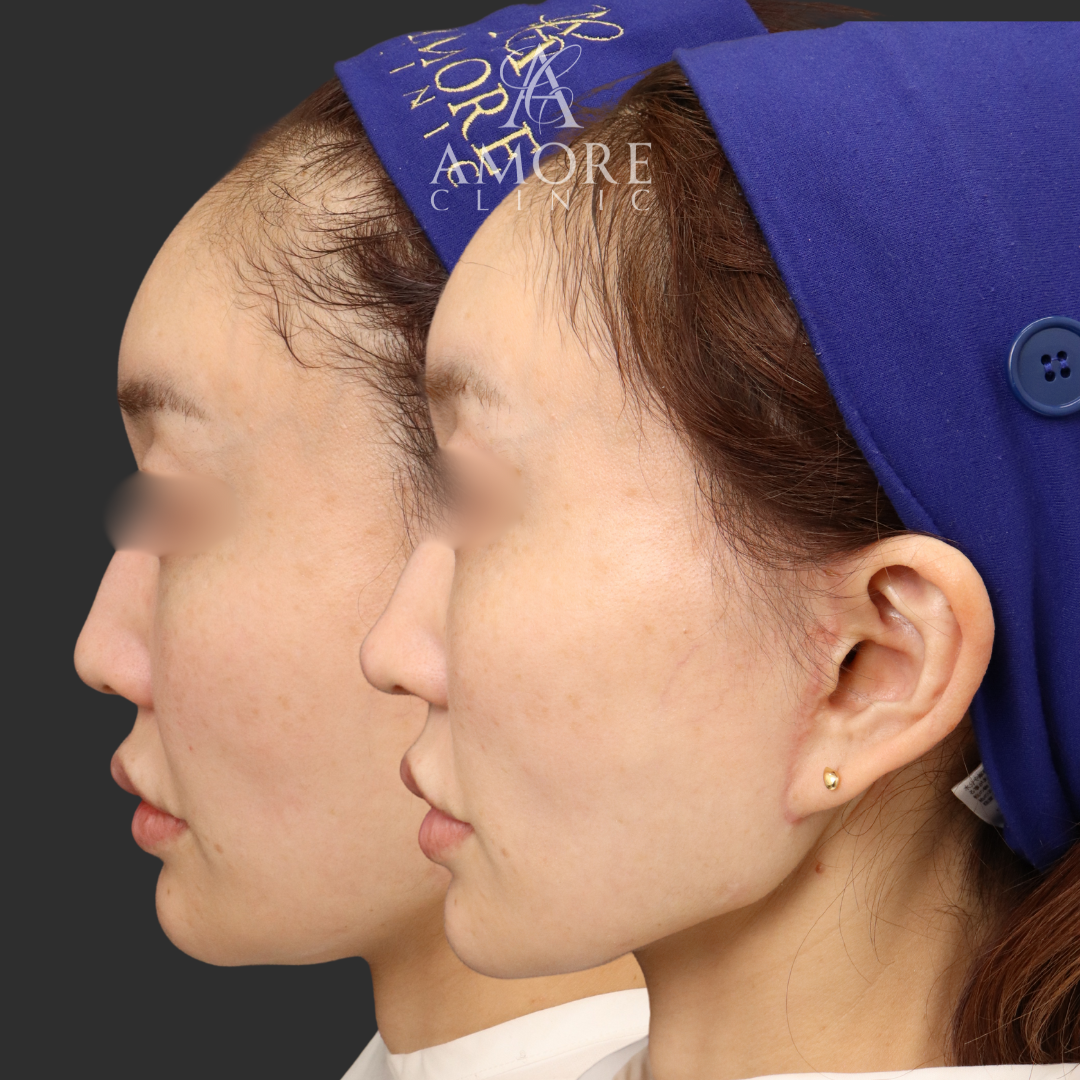 鼻尖縮小＋耳介軟骨移植＋鼻孔縁挙上＋鼻翼挙上