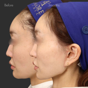 鼻尖縮小＋耳介軟骨移植＋鼻孔縁挙上＋鼻翼挙上