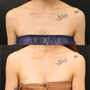 デコルテヒアルロン酸