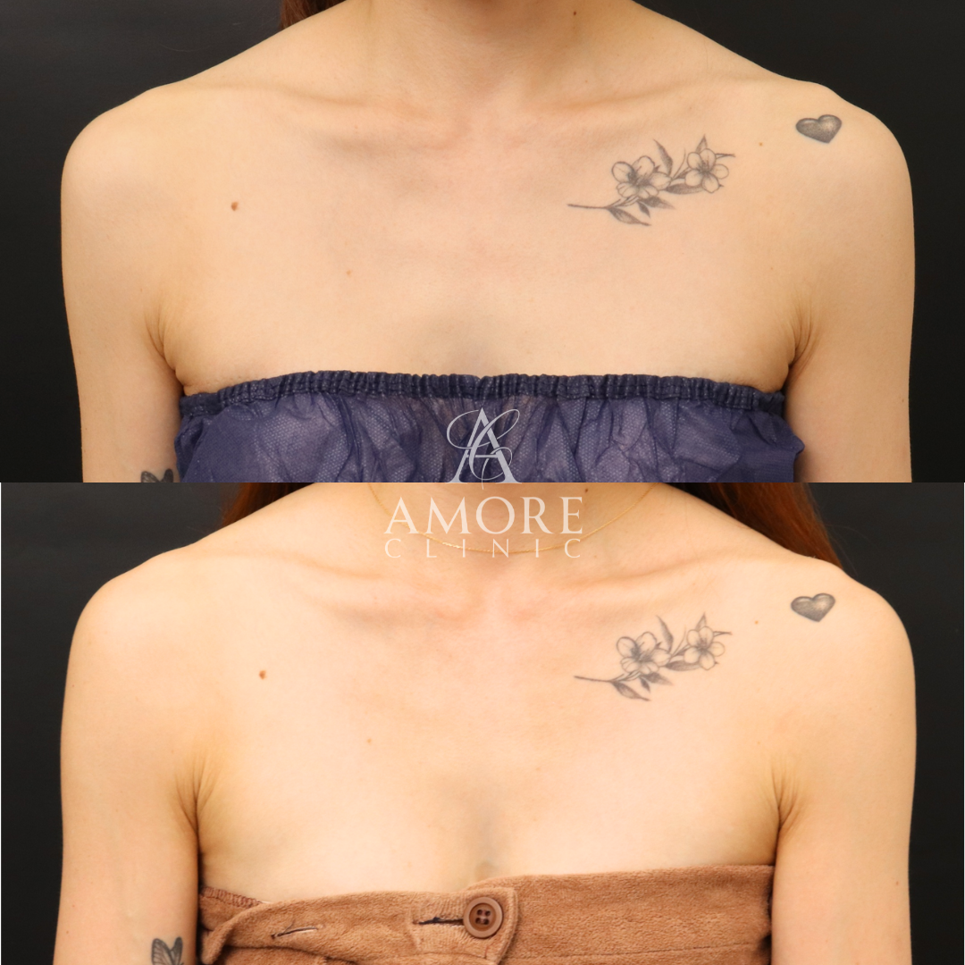 デコルテヒアルロン酸