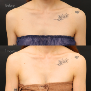 デコルテヒアルロン酸