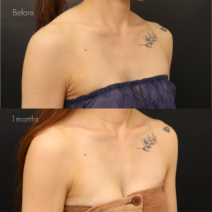 デコルテヒアルロン酸