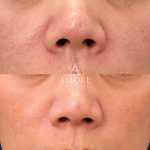 傷跡修正（TCAクロス）