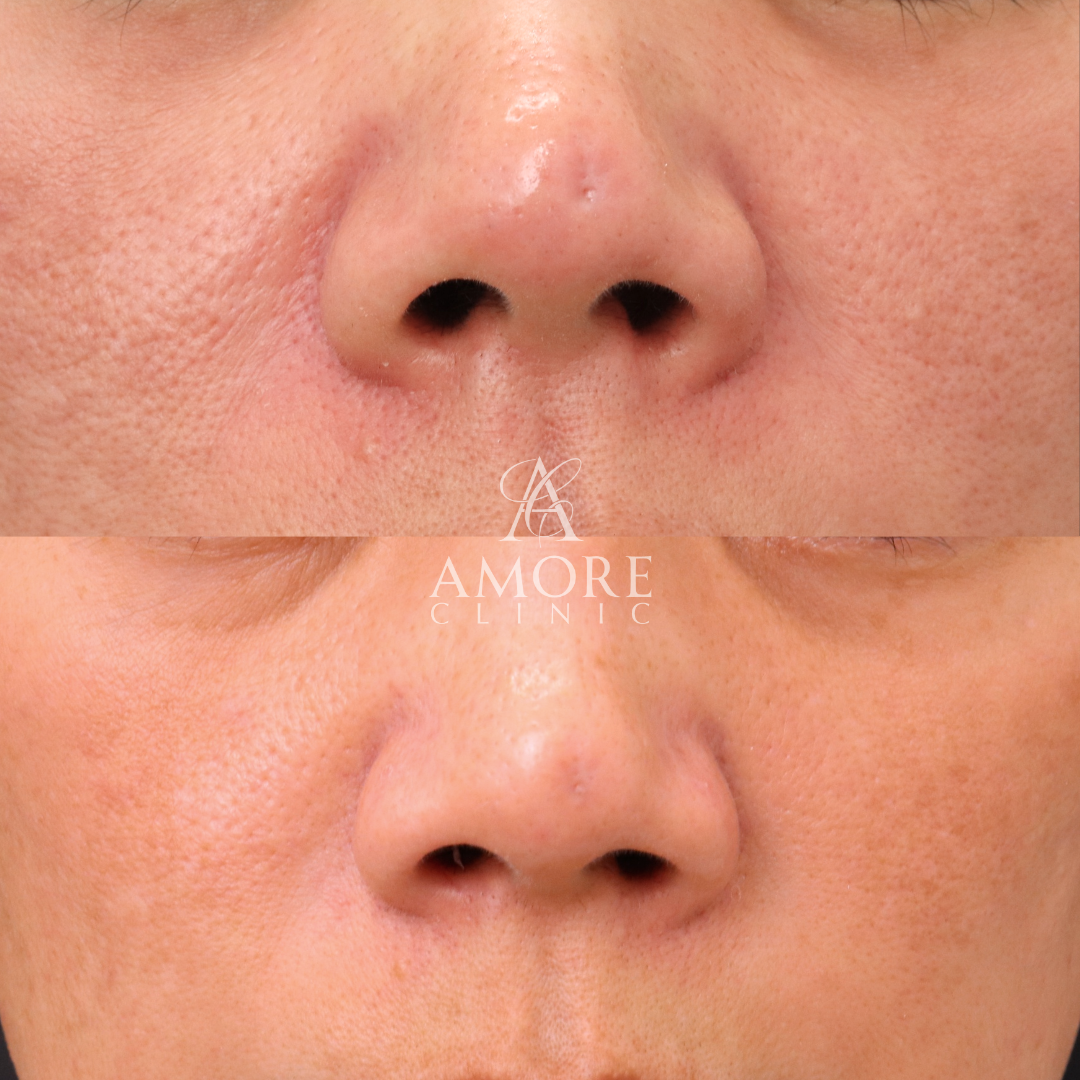 傷跡修正（TCAクロス）