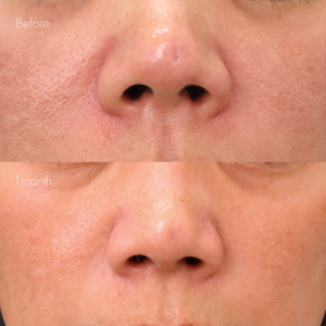 傷跡修正（TCAクロス）