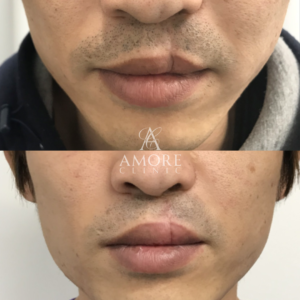 先天性口唇裂の治療（切開法）