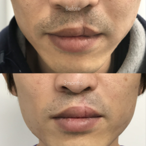 先天性口唇裂の治療（切開法）