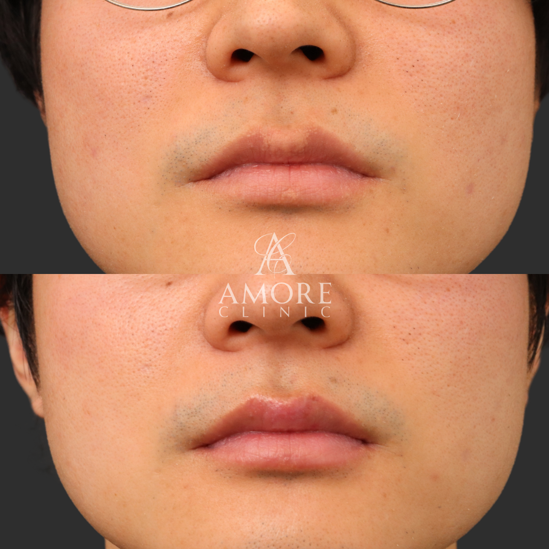 フォアダイス除去（切削法）