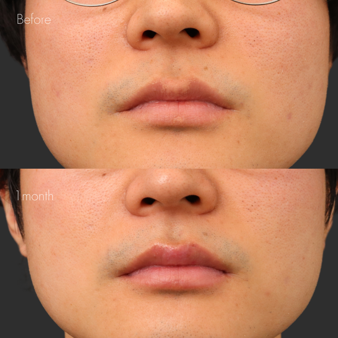 フォアダイス除去（切削法）