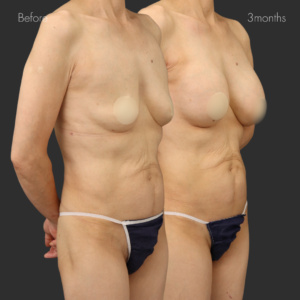 シリコンバッグ豊胸（モティバ275cc）