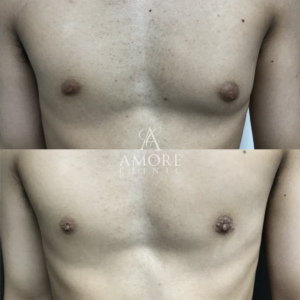 女性化乳房（乳腺・乳房脂肪除去）