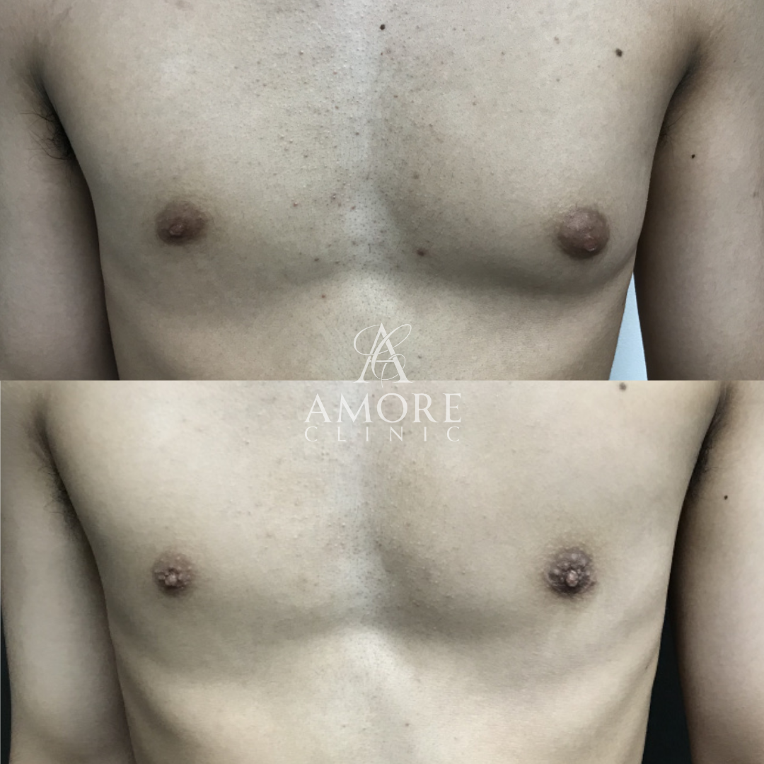 女性化乳房（乳腺・乳房脂肪除去）