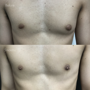 女性化乳房（乳腺・乳房脂肪除去）