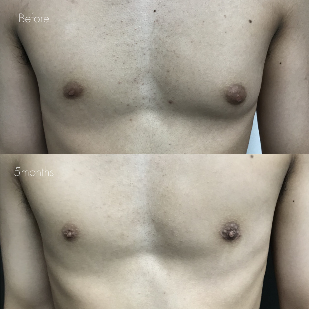 女性化乳房（乳腺・乳房脂肪除去）