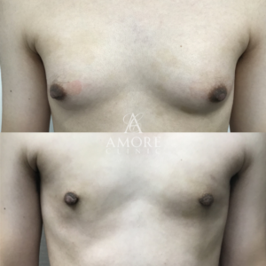 女性化乳房（乳腺・乳房脂肪除去）