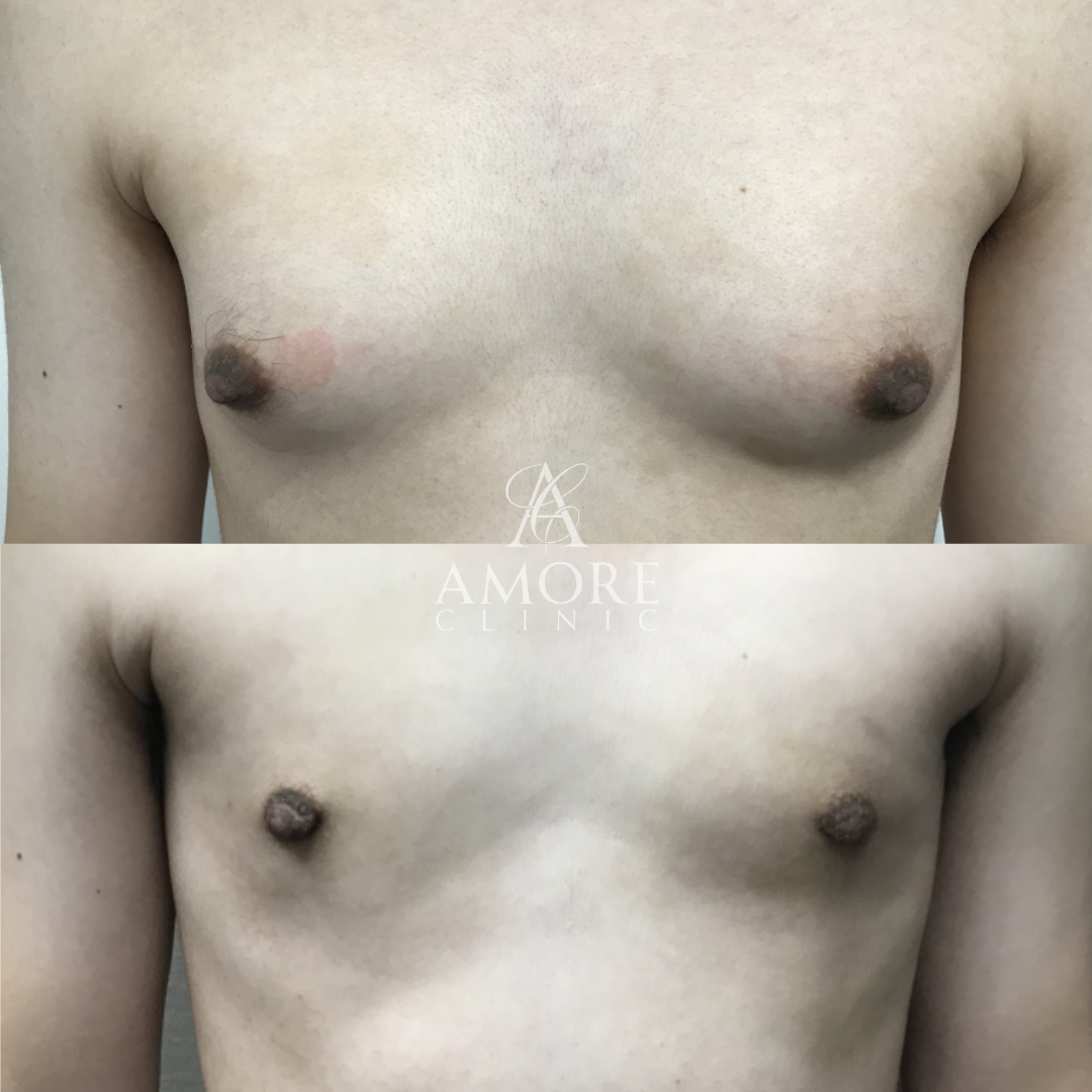 女性化乳房（乳腺・乳房脂肪除去）